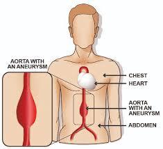 Aortic Organ Human Medical Diagram. The aorta is the main blood vessel in the body. It runs from your heart down through your chest and your abdomen. In some people, as they get older, the wall of the aorta in the abdomen can become weak. It can then start to expand and form a bulge or balloon, this is called an aneurysm. 