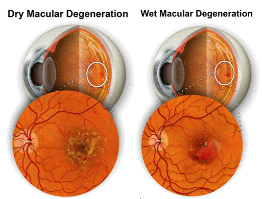 Image of two eyes, one with dry macular degeneration and other with wet macular degeneration