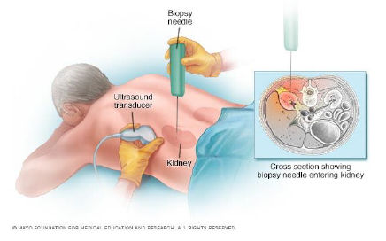 Diagram of renal biopsy being done showing ultrasound, biopsy needle and exploded diagram of needle in kidney