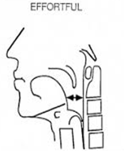 anatomical diagram of side view of throat moving in an effortful swallow. Arrow indicates movement