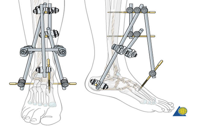 Diagram of lower leg and foot with pins sited to stabilise fracture