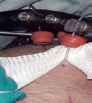 Image of pins in situ on a person being cleaned with gauze
