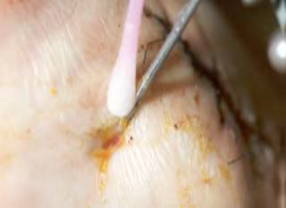 Image of pin site crusting being cleaned with a cotton bud