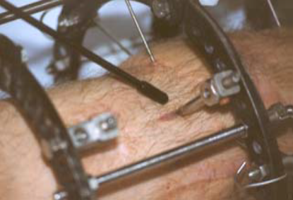 Image of pin site on leg