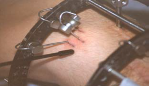 Image of pin sites on leg with some redness of skin tone