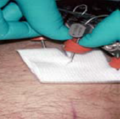 Dressing being placed with a bung