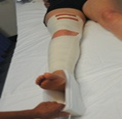 Person with fully bandaged right leg having weights applied for skin traction