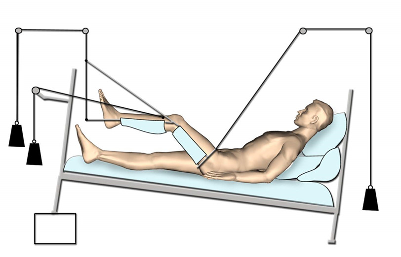 Person laid on bed with supported left leg raised in skeletal traction (pin through leg) by weighted pulley system