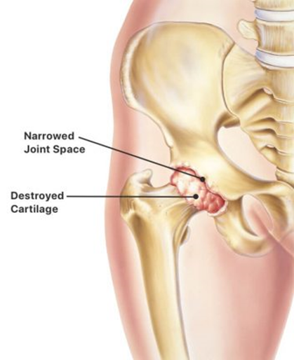 Diagram of skeletal anatomy of a hip joint with narrowed joint space and damaged cartilage