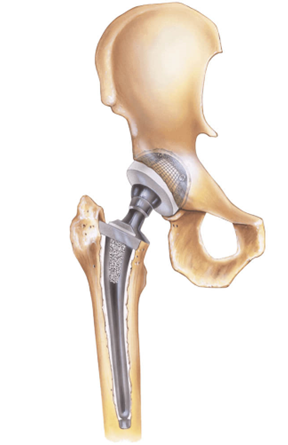 Diagram of replacement hip prothesis (new parts)