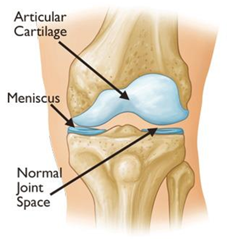 Diagram showing anatomy of knee with cartilage and normal joint space