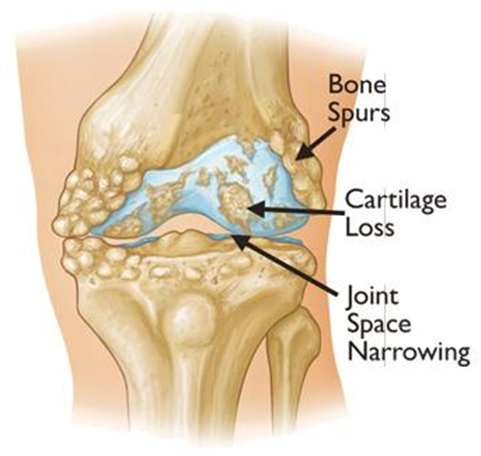 Diagram of anatomy of knee showing cartilage loss, bone spurs and narrow joint space