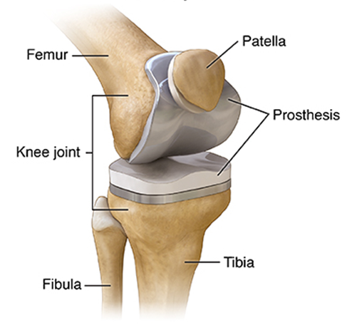 Diagram of knee replacement prosthesis (new parts)