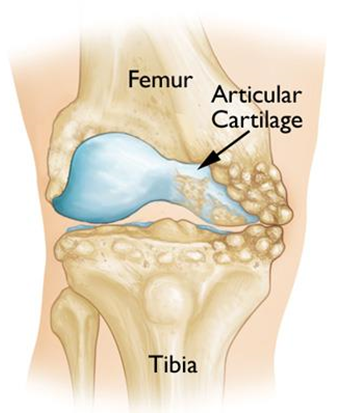 Front view of medial compartment arthritis in the right knee. Knee cap (patella) not shown.