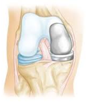 Front view of a unicompartmental knee replacement in place.