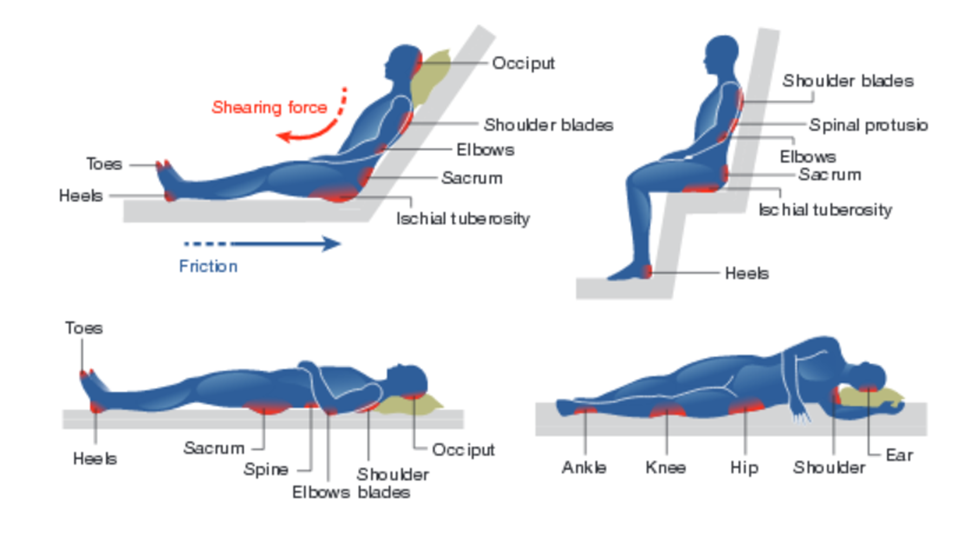 Four diagrams showing areas on body where pressure ulcers (bed sores) might develop when sitting legs up (1) or down (2) or lying on back (3) or side (4)