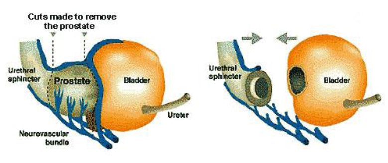 Showing how cuts are made to remove prostate from between bladder and urethral sphincter