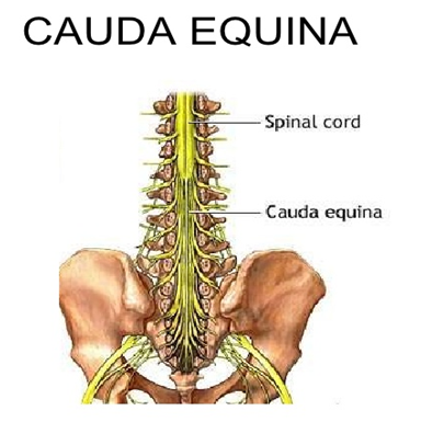 Anatomical diagram of spine and pelvis showing nerve cluster called Cauda Equina