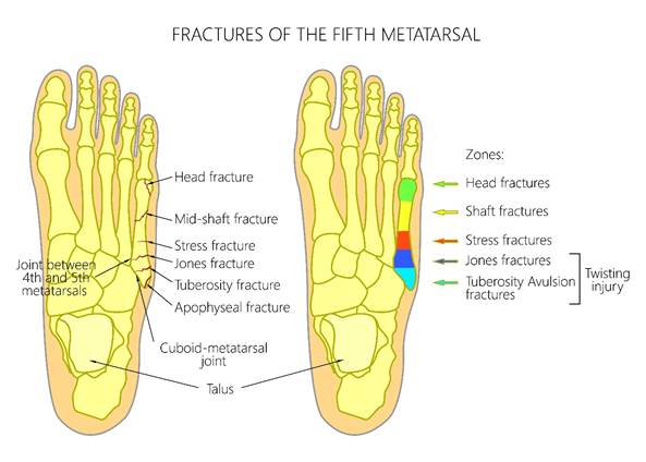 Diagram of skeletal anatomy of foot showing fifth metatarsal fracture types