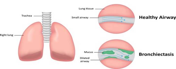 Simple diagram of lungs a healthy airway and a mucus filled airway