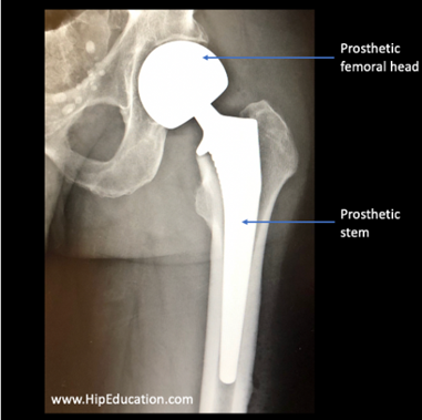 Xray image showing hip replacement prosthetic