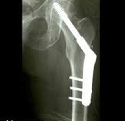 Xray image showing hip fixing screw