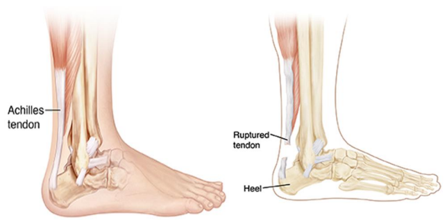 Anatomical diagram showing the muscles and tendons of the foot, ankle and lower leg where the Achilles tendon is torn (ruptured)