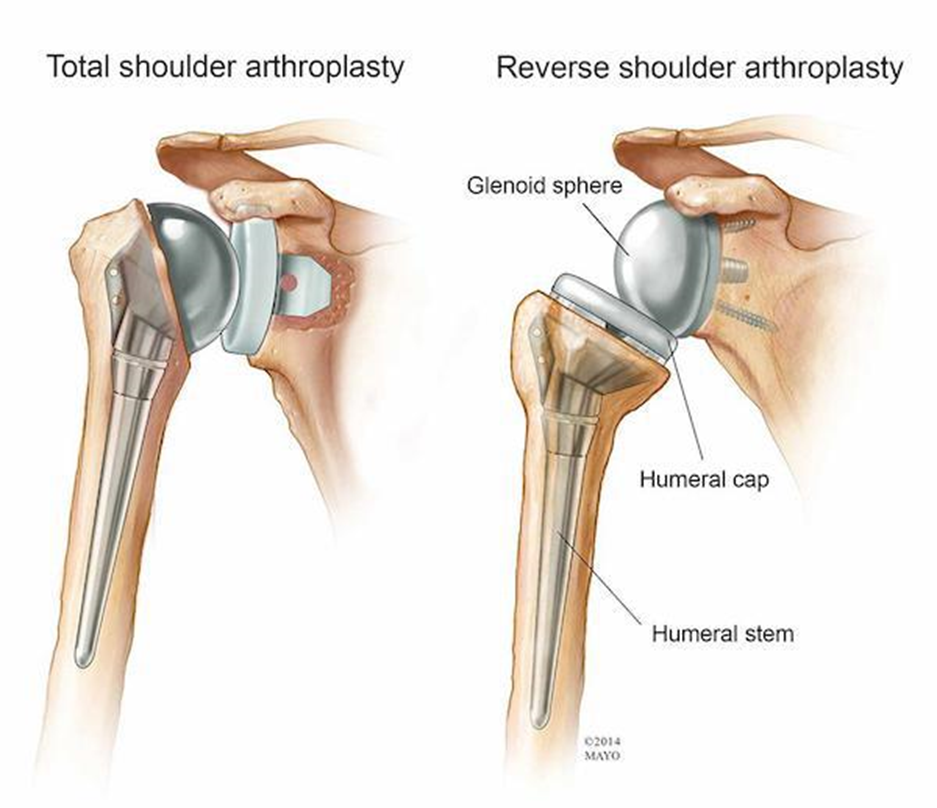 Anatomical diagram showing the view of a total shoulder replacement and a reverse shoulder replacement