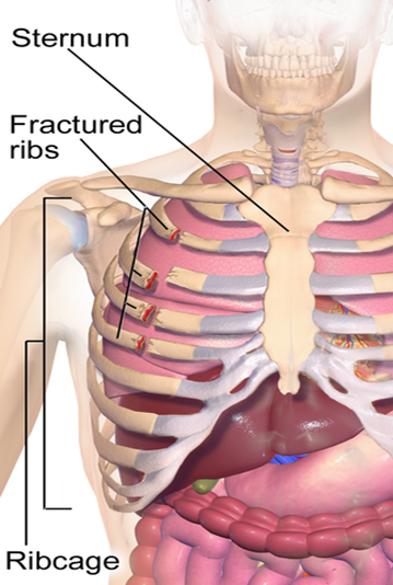 Anatomical diagram of chest showing sternum, fractured ribs, ribcage
