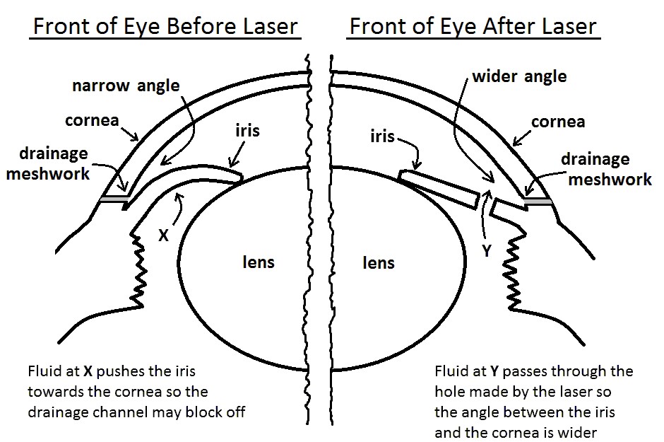 Pictures of 'cross section' of eye before and after laser showing how the iris is pushed forward by fluid before the laser and how the iris flops backwards after laser