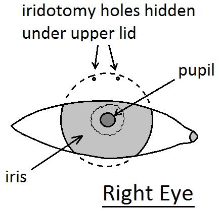 Picture of front of eye showing laser holes in the iris hidden under the upper lid