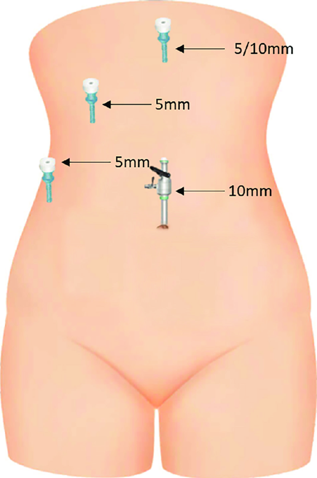 showing a laparoscopic Cholecystectomy incision sites