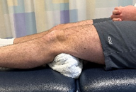 A person lying on their back with a rolled-up towel behind their knees.