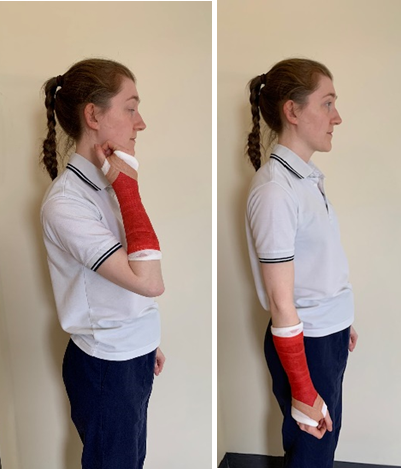 A person with their right arm in a cast raising their hand to their face and lowering it again.