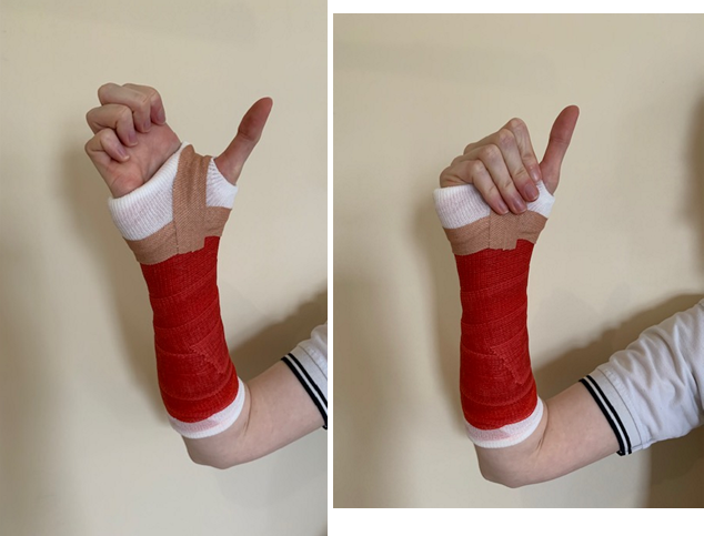 A hand in a cast with fingers touching the top of the palm and then the bottom of the palm.