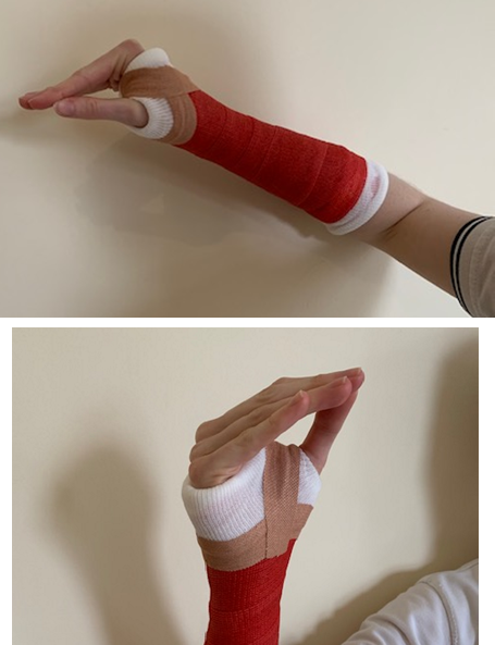 A hand in a cast with the thumb touching the ends of the other fingers.