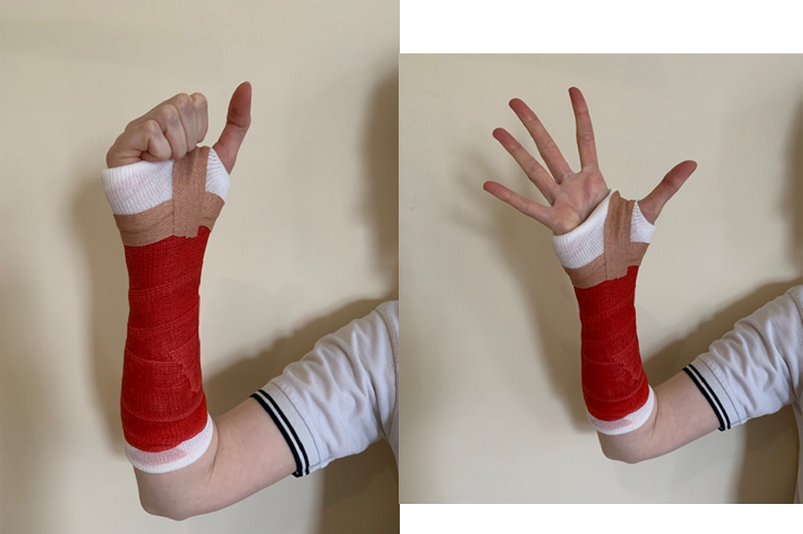 A hand in a cast making a fist, and then splaying out its fingers.