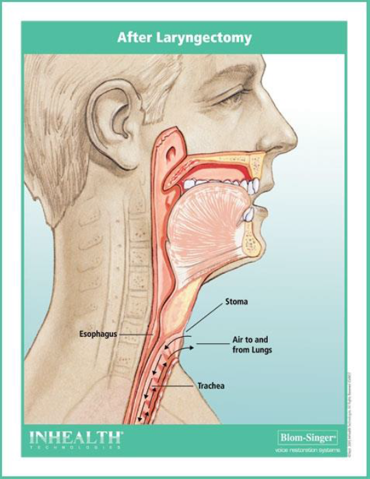 Anatomical diagram of inner jaw and throat showing the stoma site and air flow in the windpipe
