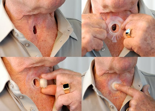 A person inserting a baseplate and cassette into their stoma.