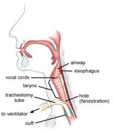 A labelled diagram of a tracheostomy and its inserted tube.