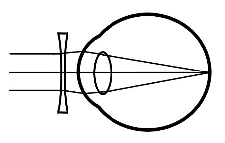 Picture of a myopic eye with glasses - Light from a distant object is focused on the retina, giving sharp vision