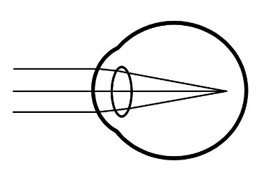 Picture of a myopic eye - light from a distant object is focused in front of the retina, giving blurred vision
