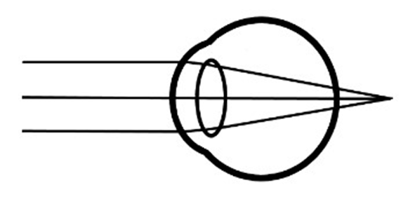 Picture of a Hyperopic eye