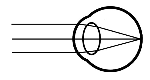 Picture of a Hyperopic eye with extra focusing effort