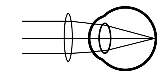 Picture of Hyperopic eye with glasses