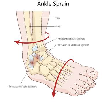 Diagram of ankle showing skeleton and ligaments. Red arrows show how the ankle can be twisted and injured