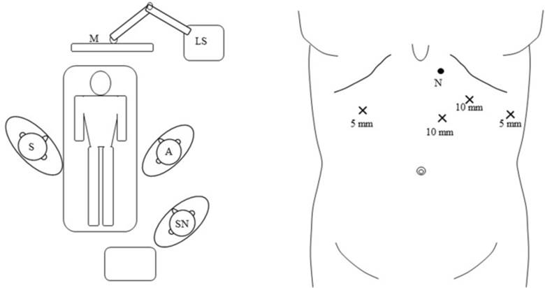Left diagram showing example of person on table in operating theatre with clinicians and equipment. Right diagram gives examples of incision sites and sizes on torso using X