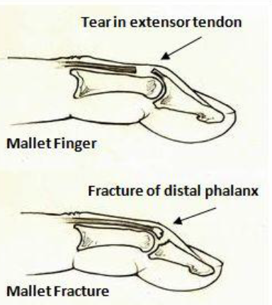 Anatomy of finger end showing first two knuckles and the types of mallet injury (tendon tear or fracture)