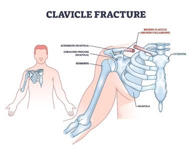 Diagram of upper chest and shoulder skeleton with clavicle (collar bone) fractured