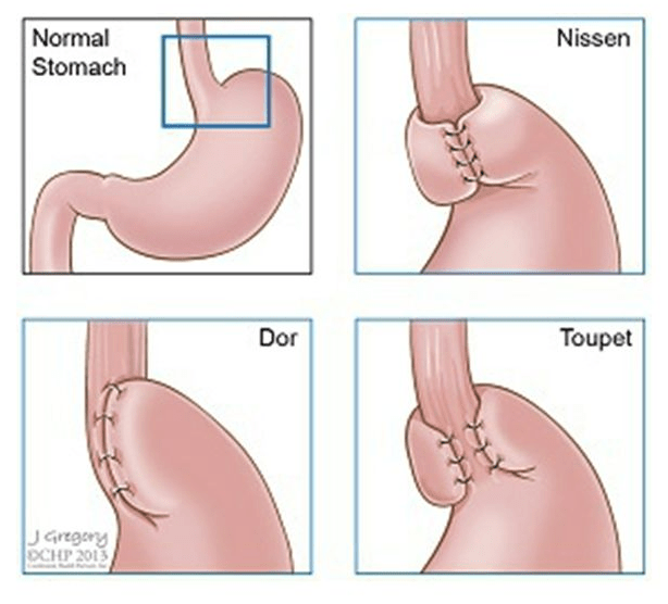 Four diagrams showing examples of a normal stomach and three different stomachs stitched using different tightening techniques